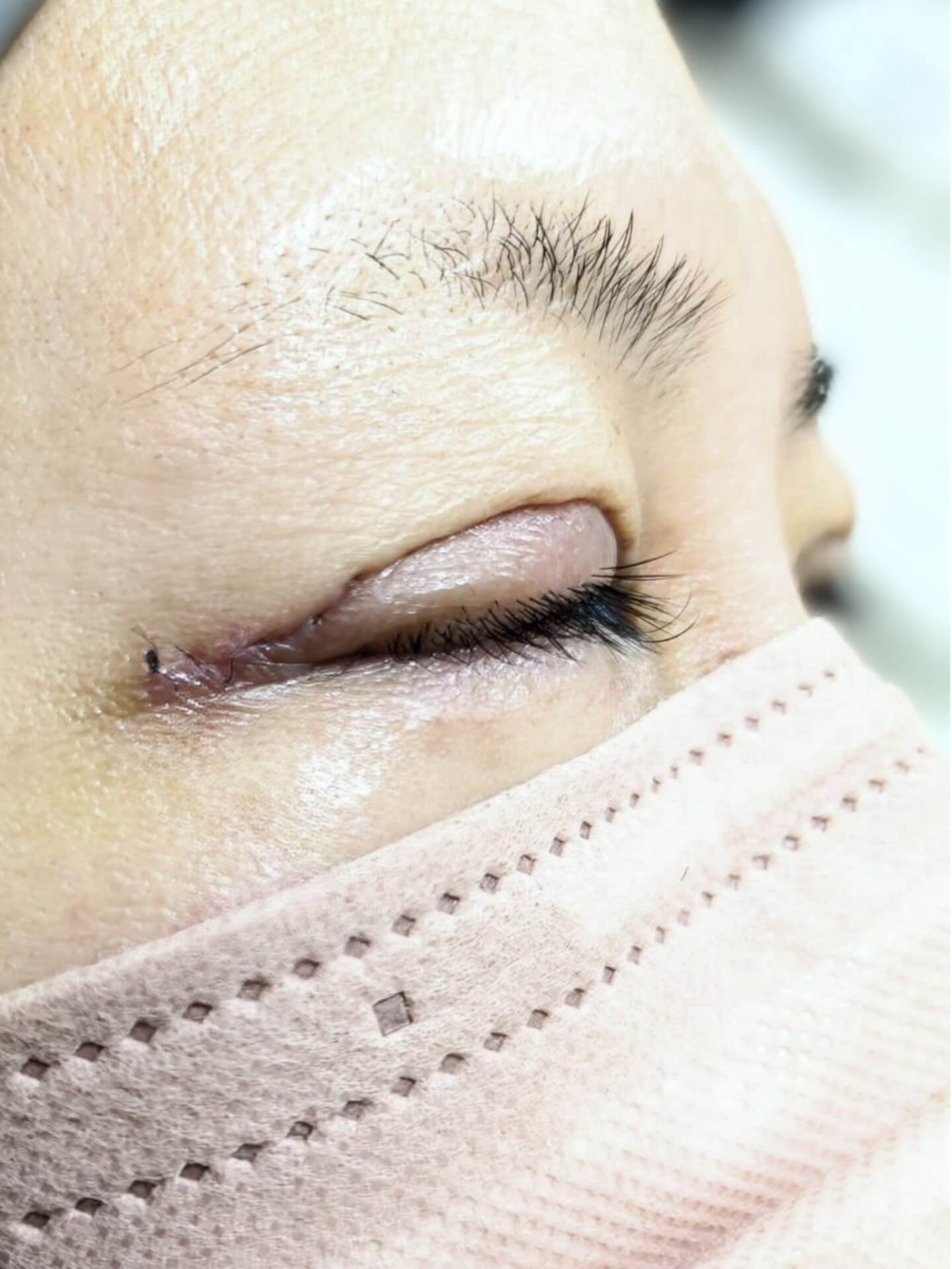 眼瞼下垂について相談する方のよくあるお悩みとは？
