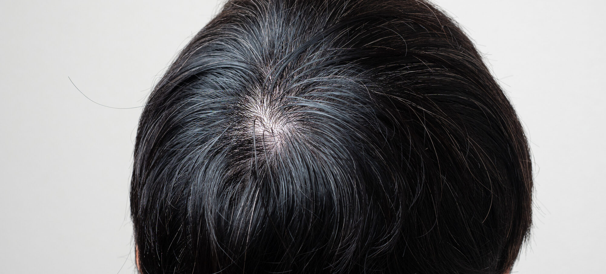 円形脱毛症はAGAとどう違うのか？特徴や原因、治療法を解説